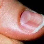 ноготь с ямкой на ногтевой пластине